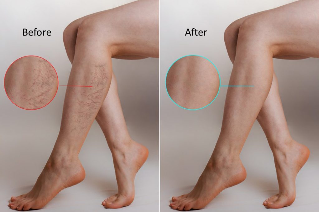 spider vein removal