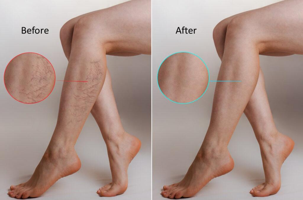 OK Spider Vein Removal in Lafayette, CO Aesthetic Solutions Inc